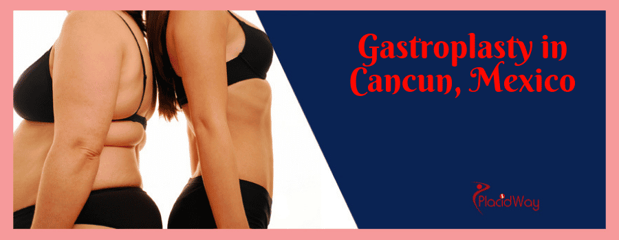 Gastroplasty in Cancun, Mexico